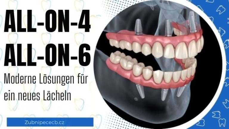 All-on-4® und All-on-6®: Moderne Lösungen für ein neues Lächeln ohne Kompromisse