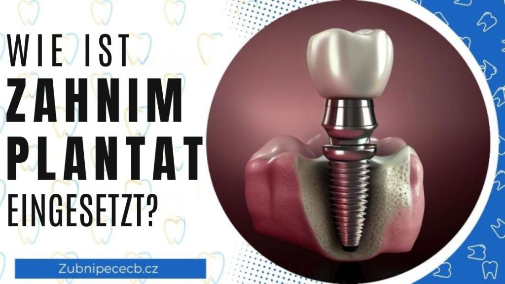 Wie wird ein Zahnimplantat eingesetzt?
