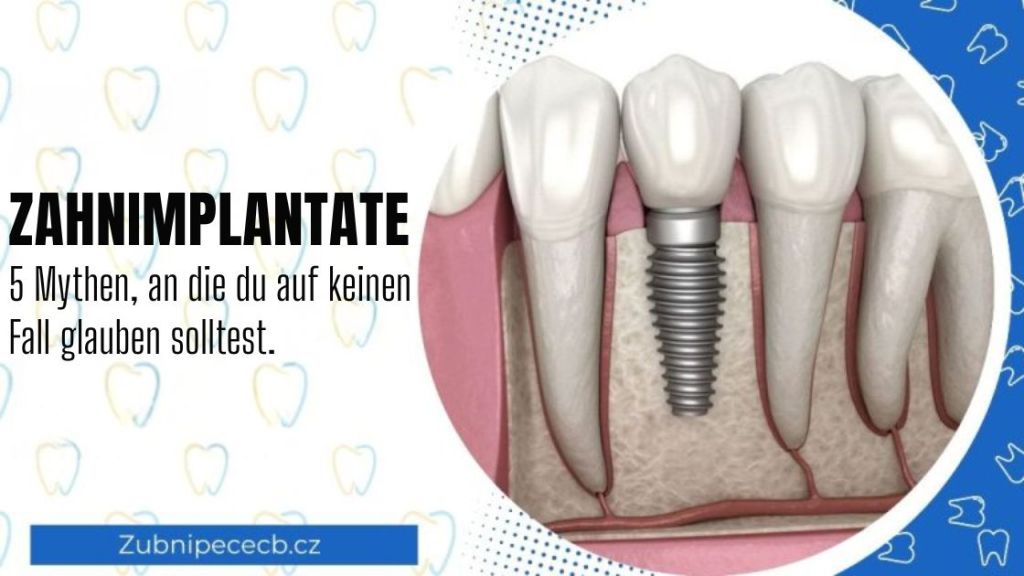 Zahnimplantate ohne Mythen: 5 Irrtümer, die Sie nicht glauben sollten