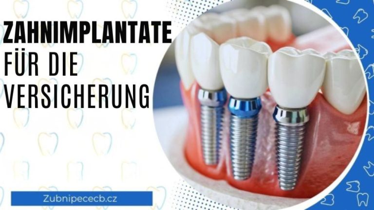 Zahnimplantate mit Versicherungsschutz: Welche Möglichkeiten gibt es und wann wird der Eingriff von der Versicherung übernommen?