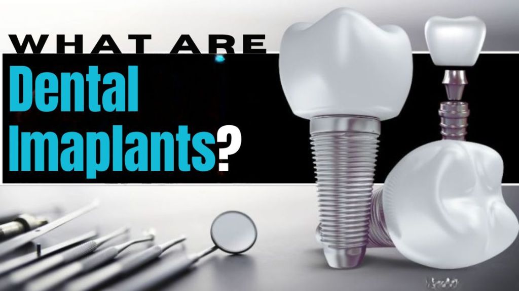 What are dental implants?