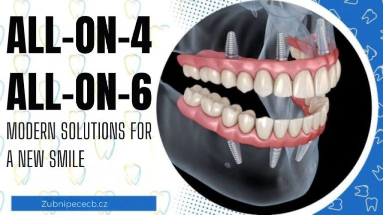 All-on-4® and All-on-6®: Modern solutions for a new smile without compromise