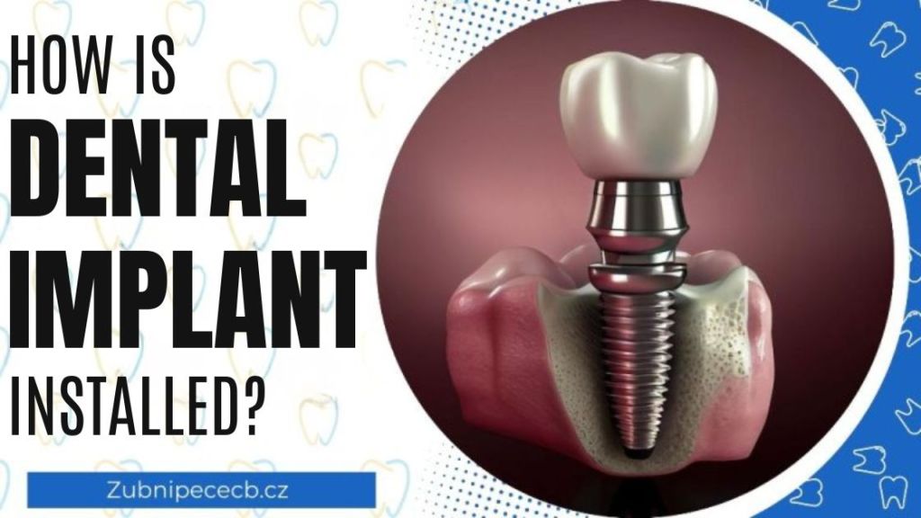 How is a dental implant inserted?