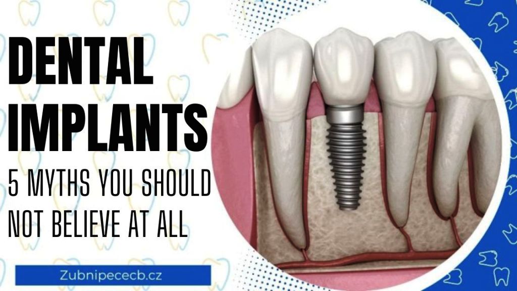 Dental implants without myths: 5 misconceptions you shouldn’t believe