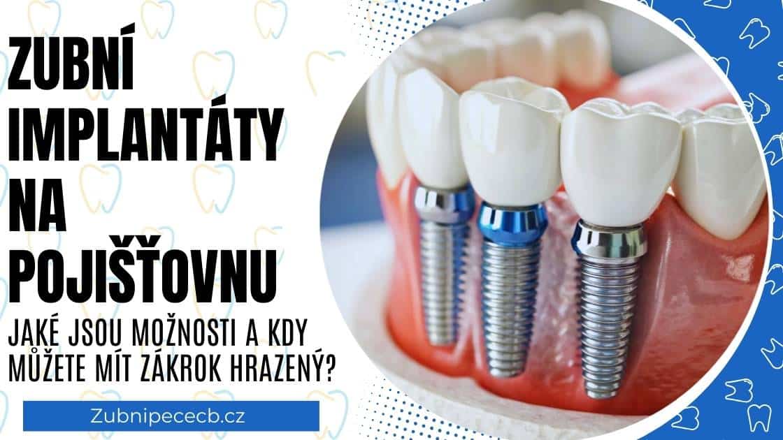 Zubní implantáty České Budějovice – kdy a proč je vhodné je zvolit